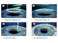 苏州近视手术助力征兵：全飞秒、全光塑等术式可选，提前半年手术是硬性规定​